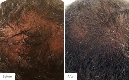 5 - Before and After Real Results picture of a man's scalp.