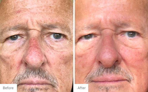 1 - Before and After Real Results photo of a man's face.